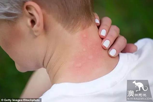 Watch out for mosquitoes! The Ross River virus has broken out in various urban areas of Australia.