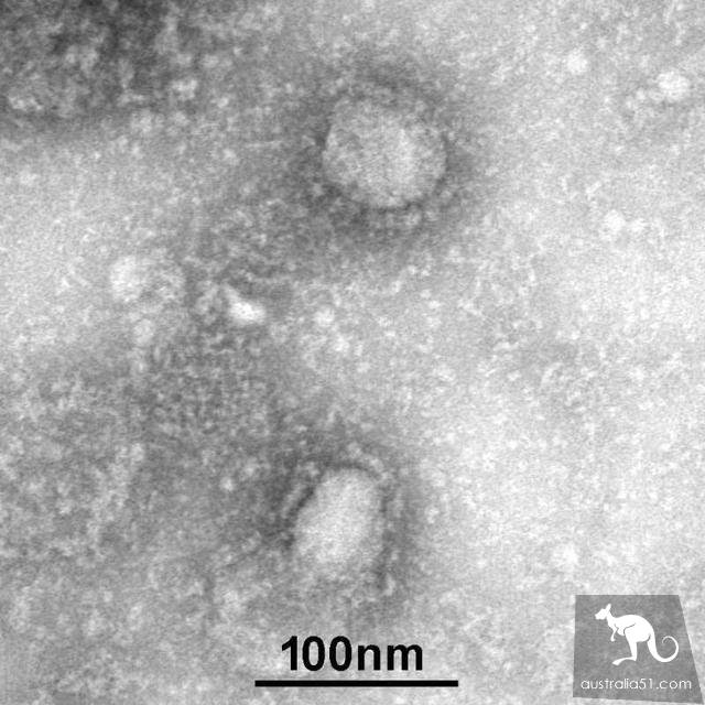 New coronary pneumonia, how can we recognize infectious diseases?