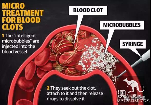 A heart attack, a stroke! Australian Chinese female Ph.D. Invents cool techs