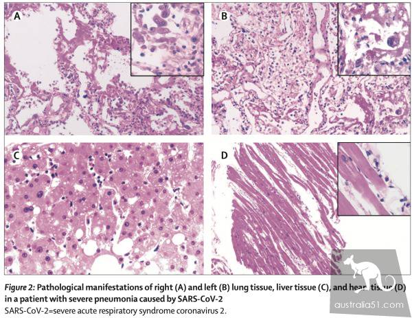 First new coronary pneumonia pathology report released from minimally invasive remains sampling