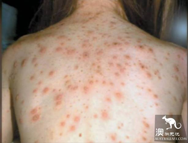 Sydney Christmas measles cases, patients have visited CBD downtown