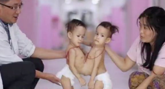 Bhutanese conjoined baby arrives in Melbourne for surgery, or one person dies